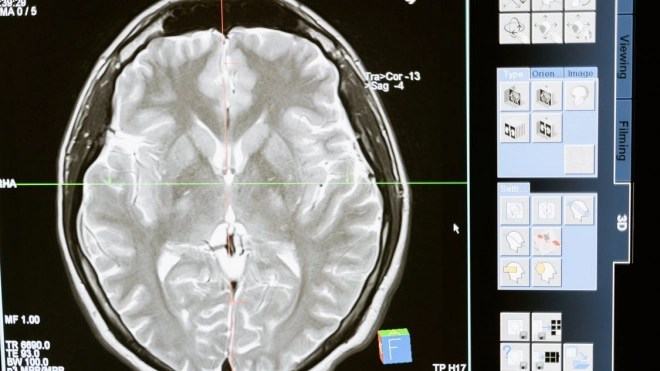 Российские ученые обнаружили аномалии в головном мозгу переболевших COVID-19