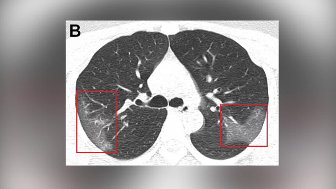 Китайские медики показали снимки легких, которые поражены коронавирусом