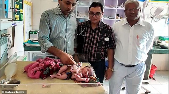 В Индии родился ребенок с четырьмя ногами и тремя руками