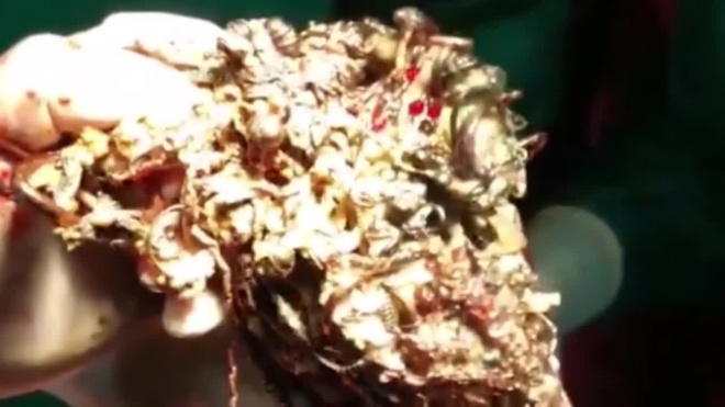В Индии хирурги извлекли из желудка девушки 1,6 кг золотых украшений