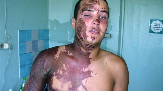 В Приморье сожженного кислотой солдата вместо госпитализации мыли в луже